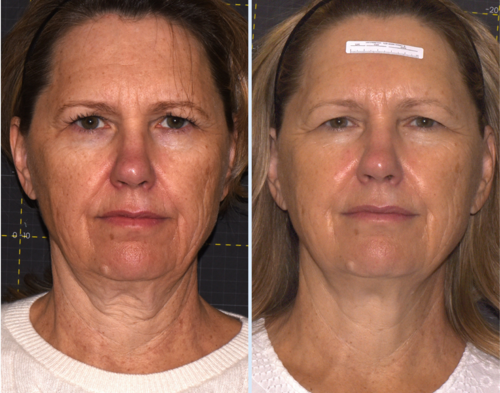 softwave-lifting-enermedica-prima-e-dopo-1