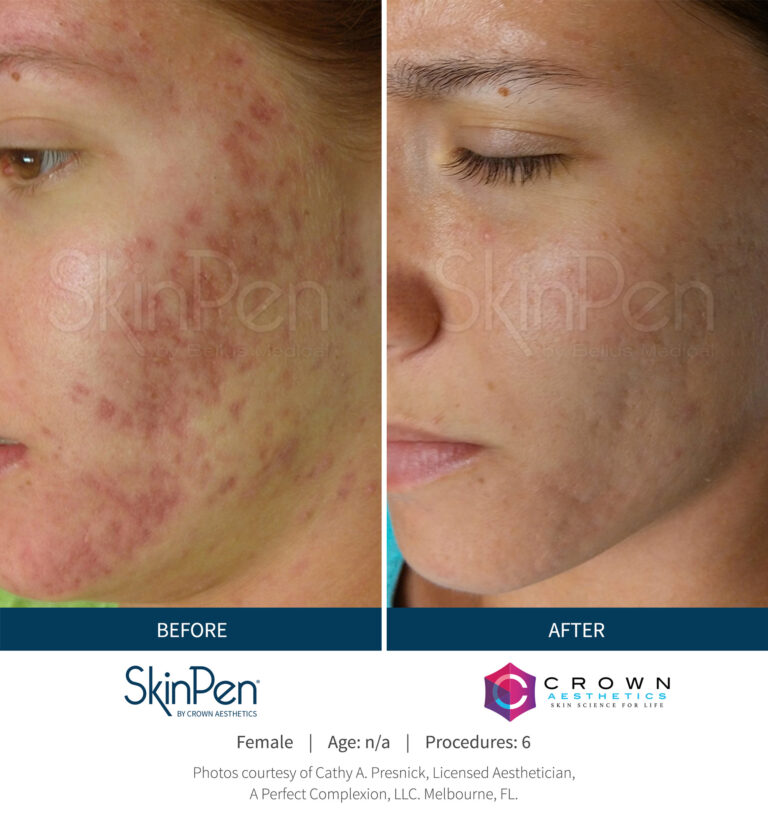 SkinPen_Acne_Melbourne_Female_NA_Before-and-After-Picture (1)