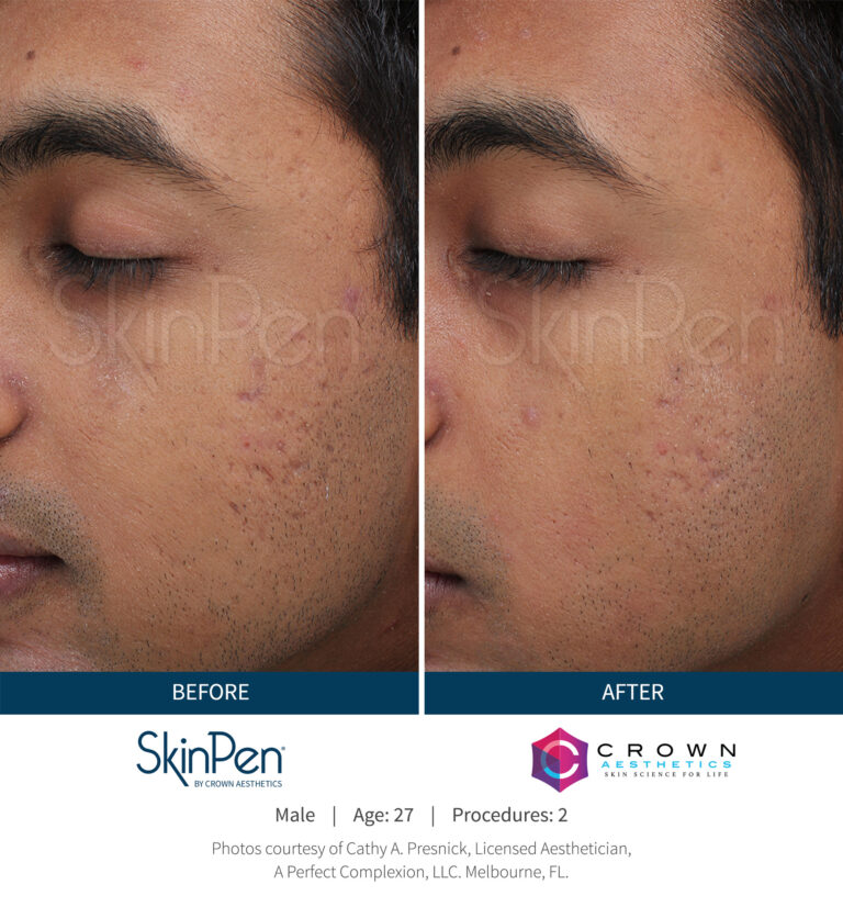 SkinPen_Acne_Melbourne_Male_27_Before-and-After-Picture